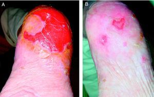 A. Úlcera en pie derecho. B. Respuesta a los 6 meses de tratamiento con tacrolimus tópico dos veces al día.