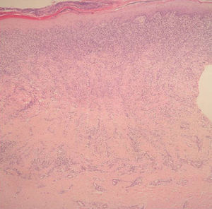 Atrofia epidérmica, infiltrado en banda de aspecto liquenoide y células plasmáticas. Hematoxilina-eosina, x40.