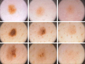 Se muestran varios ejemplos de despigmentación paulatina sin halo de varios nevos melanocíticos.