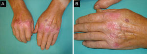 A y B. Eritema violáceo no pruriginoso, bilateral y confluente, que afecta a la piel localizada principalmente sobre las articulaciones metacarpofalángicas.