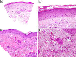 A. Presencia de queratinocitos con pérdida de la polarización y múltiples mitosis en la capa basal y suprabasal epidérmicas, junto con la existencia de un infiltrado linfocitario intraepidérmico y perivascular superficial (hematoxilina-eosina; x25). B. Múltiples queratinocitos con citoplasma eosinofílico y edematoso y núcleo hipercromático, con nucleolo prominente, organizados en un patrón «pseudoestratificado» en el tercio inferior de la epidermis (hematoxilina-eosina; x 100). C y D. Presencia de cambios en los ductos dérmicos ecrinos compatibles con siringometaplasia escamosa ecrina (hematoxilina-eosina; C: x25; D: x100).