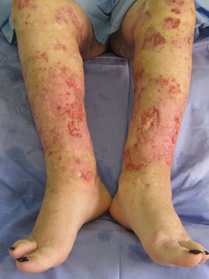 Úlceras en miembros inferiores con borde irregular y socavado.