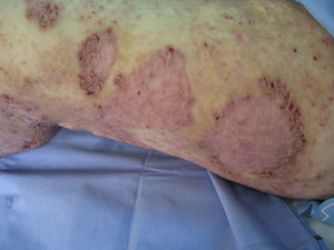 Cicatrices de úlceras de brotes de pioderma gangrenoso previos, con aspecto cribiforme en la periferia y papulopústulas superpuestas en algunas de ellas.