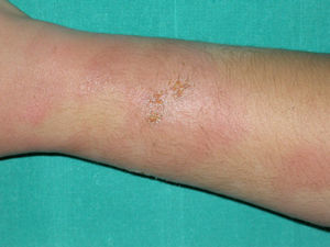 Limpiadora de pescado que presentó una dermatitis aguda a las 24 horas de reincorporarse a su trabajo tras una baja laboral.