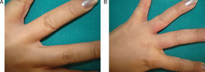 El rub test con alimentos, o el test de uso con un guante de látex, produce lesiones inmediatas de eczema donde había existido una dermatitis previa. A. Antes de realizar la prueba. B. Dermatitis aguda a los 20 minutos de colocar un guante de látex.