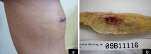 A. Masa subcutánea mal delimitada en la zona pretibial derecha, de rápido crecimiento en las últimas semanas, inicialmente diagnosticada de lipoma. B. Imagen macroscópica: tumor multinodular subcutáneo mal delimitado de 5x6,5x2cm, de aspecto gelatinoso y presencia de áreas hemorrágicas, que infiltra tejido adiposo y la grasa perióstica en forma de nódulos tumorales.