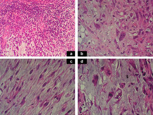 A. Hematoxilina-eosina x200: focos de infiltrado inflamatorio polimórfico denso, con presencia de linfocitos, células plasmáticas, neutrófilos y numerosos eosinófilos, inmerso en la matriz mixoide, formando parte del tumor. B. Hematoxilina-eosina x400: población tumoral constituida por células tumorales multinucleadas a tipo Reed-Sternberg, y células epitelioideas. C. Hematoxilina-eosina x400: células tumorales de morfología fusiforme. D. Hematoxilina-eosina x400: células multivacuoladas de tipo lipoblasto.
