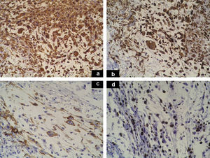 Tinciones inmunohistoquímicas. A. Marcada positividad de las células tumorales para vimentina. B. Positividad moderada de las células tumorales para CD68. C. Positividad de las células tumorales para CD34. D. Índice de proliferación tumoral con el marcador Ki67 que mostraba una positividad del 20-30%.