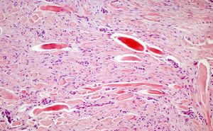 Proliferación de células fusiformes entre fascículos queloideos de colágeno. (H-E; ×150).