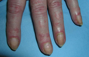 Eritema periungueal y cutículas hipertróficas presentes en todos los dedos de la mano.