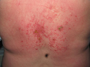 Lesiones cutáneas necróticas en la espalda.