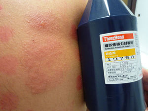 El material sellante Threebond®, responsable de la dermatitis de contacto alérgica en nuestros pacientes. En el tercer paciente la concentración de Threebond al 2% provocó incluso una reacción vesiculosa.