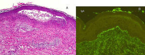 A. El estudio con hematoxilina-eosina (x 20) de una de las lesiones ampollosas muestra numerosos infiltrados neutrofílicos en las papilas dérmicas y la presencia de una ampolla en la unión dermoepidérmica, sugestivos de dermatitis herpetiforme. B. La inmunofluorescencia directa de la piel sana perilesional pone de manifiesto los depósitos de IgA de forma granular en la dermis papilar, propios de la dermatitis herpetiforme.