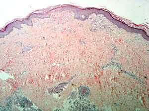 H-E x4. Necrosis incipiente de la epidermis y, en la dermis, imágenes de congestión vascular con extravasación hemática y trombosis e hialinosis parietal. De forma parcheada, en los vasos dermohipodérmicos, focos de necrosis fibrinoide segmentaria con leucocitoclasia e infiltrado mixto.
