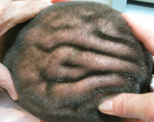Imagen clínica en la que se aprecian los surcos y circunvoluciones en el cuero cabelludo del paciente.