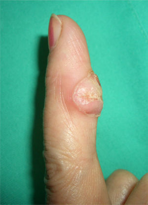 Características clínicas de la exostosis de Turret, emergiendo de la cara palmar del tercer dedo de la mano derecha de nuestra paciente.