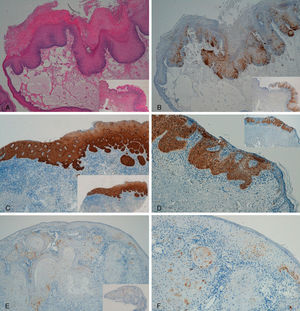 A y B: Carcinoma intraepidérmico de pene (PeIN). Tinción positiva para p16 en tercio inferior de epidermis (PeIN-I) (A y B: H-E x40, p16x40, panorámica x16 en recuadros). C: Carcinoma intraepidérmico de vulva (VIN), positivo para p16 en toda la epidermis (VIN-III), con algún foco microinfiltrante en dermis (p16x40, panorámica x16 en recuadro). D: Carcinoma intraepidérmico de pene. Tinción positiva en toda la epidermis (PeIN-III) (p16x40, panorámica x16 en recuadro). E-F: Carcinoma epidermoide invasor de vulva, tinción p16 negativa en el tumor (E: p16x40, panorámica x16 en recuadro. F: p16x100).