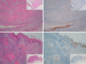 Carcinoma epidermoide invasor de área extragenital. Tinción focalmente positiva para p16 en epidermis adyacente al carcinoma con displasia severa y/o queratosis actínica, negativa en el área invasora del tumor (A-C: H-E x40, panorámica x16 en recuadros. B-D: p16x40, panorámica x16 en recuadros).
