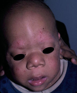 Síndrome cardio-facio-cutáneo. Facies típica de síndrome donde se aprecia el uleritema ofriógenes en cejas característico (cortesía de la Dra. Eulalia Baselga).