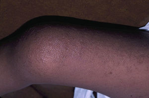 Síndrome cardio-facio-cutáneo. Hiperqueratosis folicular en el miembro superior (cortesía de la Dra. Eulalia Baselga).