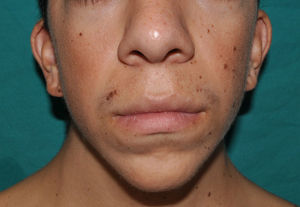 Síndrome de Noonan. Aspecto característico del labio superior, con los ángulos superiores del borde rojo muy acentuados y un filtrum nasolabial ancho. El paciente presenta múltiples nevus melanocíticos adquiridos en la cara.