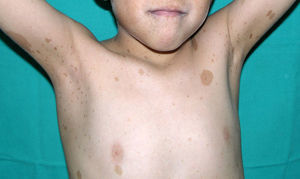 Neurofibromatosis tipo 1. El paciente presenta máculas café con leche y numerosas efélides en las axilas (signo de Crowe), el tronco e incluso en la cara.