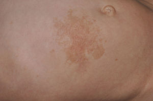 Neurofibromatosis tipo 1. Neurofibroma plexiforme superficial congénito en el abdomen.