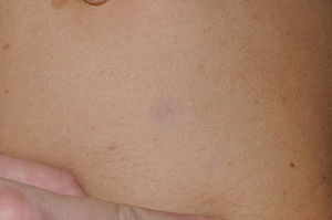 Neurofibromatosis tipo 1. Detalle de una mácula rojo-azulada, de aspecto pseudoatrófico.