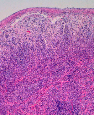 Lesión ulcerada cubierta de una escara de fibrina, con infiltrado linfoplasmocitario denso en todo el espesor de la dermis (H-E x100).