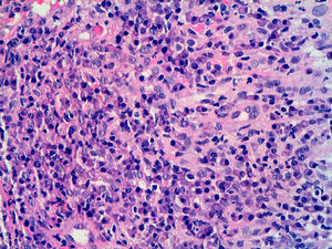 Detalle del infiltrado linfoplasmocitario, con vasos de endotelio prominente (H-E x200).