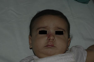 La paciente tras 5 meses y medio de tratamiento (7 meses y medio de vida).