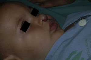 Hemangioma infantil en punta nasal en un niño de 9 meses de vida. Recibió a esa edad una infiltración local de corticoides. A la edad de 18 meses inició tratamiento con propranolol oral por persistencia de la lesión, que mantuvo durante 7 meses.