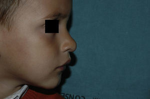 El mismo paciente a los 2 años y 10 meses de vida (9 meses después de finalizar tratamiento con propranolol).