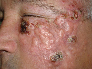 Placa cutánea de superficie irregular y brillante, con algunos puntos ulcerados. La lesión impedía la apertura ocular.