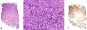 A. Denso infiltrado linfocitario que ocupa totalmente el espesor de la dermis hasta el tejido celular subcutáneo (hematoxilina-eosina, x20). B. Células linfoides de citoplasma amplio con importante pleomorfismo, actividad mitótica y atipia (hematoxilina-eosina, x200). C. Positividad intensa con el marcador CD30 en casi toda la muestra (x20).