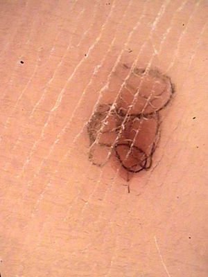 Imagen dermatoscópica: tallo piloso bajo la capa córnea.