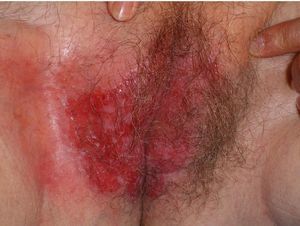 Placa eritematodescamativa con islotes blanquecinos en su interior junto a áreas erosionadas y exudativas localizada en la vulva.