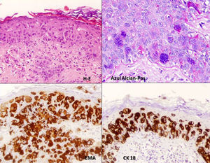 El estudio inmunohistoquímico fue positivo para CEA, EMA CK7, CK18 (x 40).
