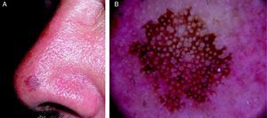 A. Imagen clínica del caso 1. Se observa una mácula pigmentada de color marrón oscuro, de 5mm, con bordes bien delimitados y con superficie algo rugosa. El borde de parte de la lesión era apolillado. B. Imagen dermatoscópica del caso 1. Estructuras romboidales y un patrón anular-granular.