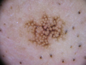 Imagen dermatoscópica del caso 2. Se aprecian puntos de color marrón-grisáceo con distribución perifolicular, estructuras romboidales y un patrón anular-granular.