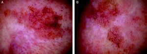 A. Imagen dermatoscópica de la lesión en el dorso nasal derecho del caso 4. Se aprecian estructuras romboidales sobre una base eritematosa y una granulación de color marrón-grisáceo de distribución difusa. B. Imagen dermatoscópica de la lesión en el dorso nasal izquierdo. En la parte inferior de la lesión se observan estructuras romboidales y un patrón anular-granular. En la parte superior se observan estas mismas estructuras con una tonalidad más rojiza y algunos vasos finos y ondulados.