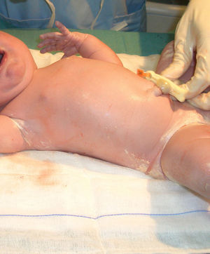 Recién nacida con vérnix caseosa localizada en los pliegues.