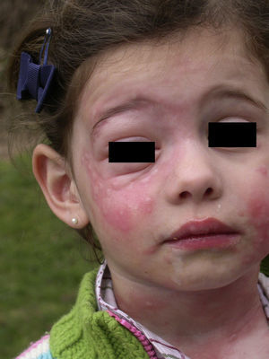 Urticaria de contacto intensa, con angioedema asociado, en la cara y el cuello de una niña de 5 años tras jugar en un arenero cercano a pinos infestados por TP.