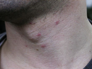 Pápulas inflamatorias e infiltradas en el cuello. Aparecieron al día siguiente del paseo por un pinar y persistieron durante 4 o 5 días con intenso picor.
