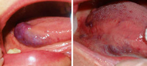 Malformación venosa de la lengua (caso 7) antes y después del tratamiento con una sola sesión de láser Nd:YAG (fluencia: 200J/cm2; tiempo: 30ms; spot: 3mm).