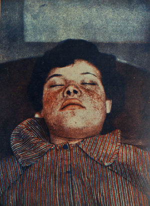 Los fotograbados en color en Actas Dermo-Sifiliográficas fueron muy escasos hasta hace relativamente pocos años. Esta imagen, que data de 1935, es uno de los primeros. Aparece en un trabajo de López Ibor, director del manicomio de Valencia, y muestra —con las imprecisiones de estos primeros grabados en color— los angiofibromas faciales de un caso de esclerosis tuberosa.