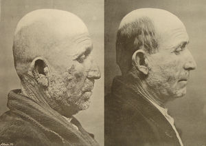 Estos dos fotograbados aparecen en un trabajo de Nonell y Serrano de 1910 sobre la crioterapia en el tratamiento del lupus vulgar. Además de su propio valor histórico, tienen el mérito de ser uno de los primeros ejemplos del «antes y después», tan habitual en nuestros actuales congresos, y de ilustrar uno de trabajos pioneros sobre la crioterapia en la literatura dermatológica europea.
