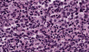 Detalle de la celularidad: proliferación neoplásica difusa constituida por células mononucleares de mediano tamaño, de morfología redondeada y oval, citoplasma eosinófilo y núcleo basófilo, presentando indentaciones algunos de ellos (HE x40).
