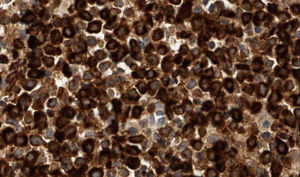 Inmunohistoquímica: positividad difusa citoplásmica para MPO.
