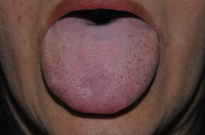 Caso 2. Pigmentación de las papilas fungiformes linguales de distribución difusa y simétrica, predominantemente en las caras laterales de la lengua en una paciente de origen étnico sudamericano.